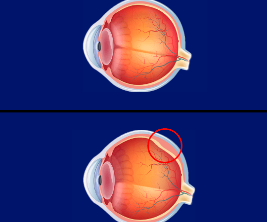 Imagem Descolamento da Retina Individual min